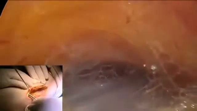 Остеопатия - удивительное видео