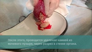Камни в мочевом пузыре. Хирургическое удаление камней из мочевого пузыря