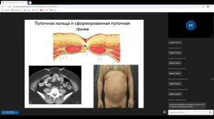 Хирургическая анатомия слабых участков передней брюшной стенки