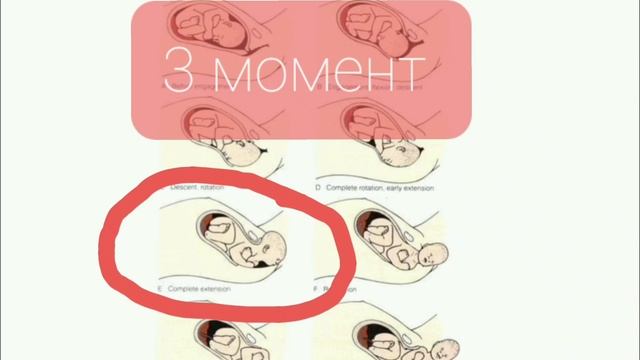 Биомеханизм родов при переднем виде затылочного предлежания