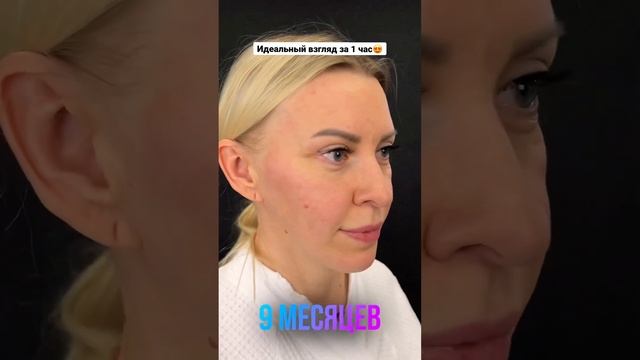 Верхняя блефаропластика? Доктор ФРОЛОВ М.М смотреть онлайн