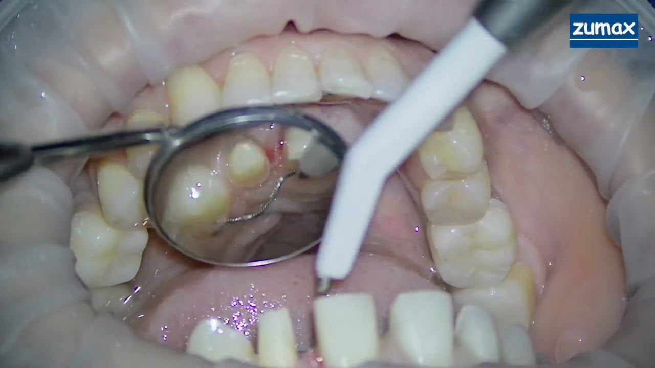 СТОМБУДНИ#35 ПРЕПАРИРОВАНИЕ ФРОНТАЛЬНЫХ ЗУБОВ ПОД ВИНИРЫ. смотреть онлайн