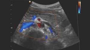 Норма почечные артерии из переднего доступа