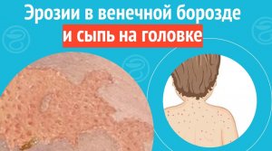 ? Эрозии в венечной борозде и сыпь на головке. Клинический случай №1081