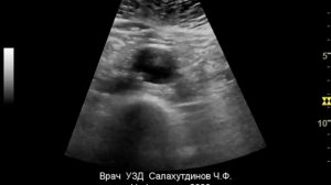 Диссекция брюшной аорты в инфраренальном отделе  с переходом     на правую общую подвздошную артери