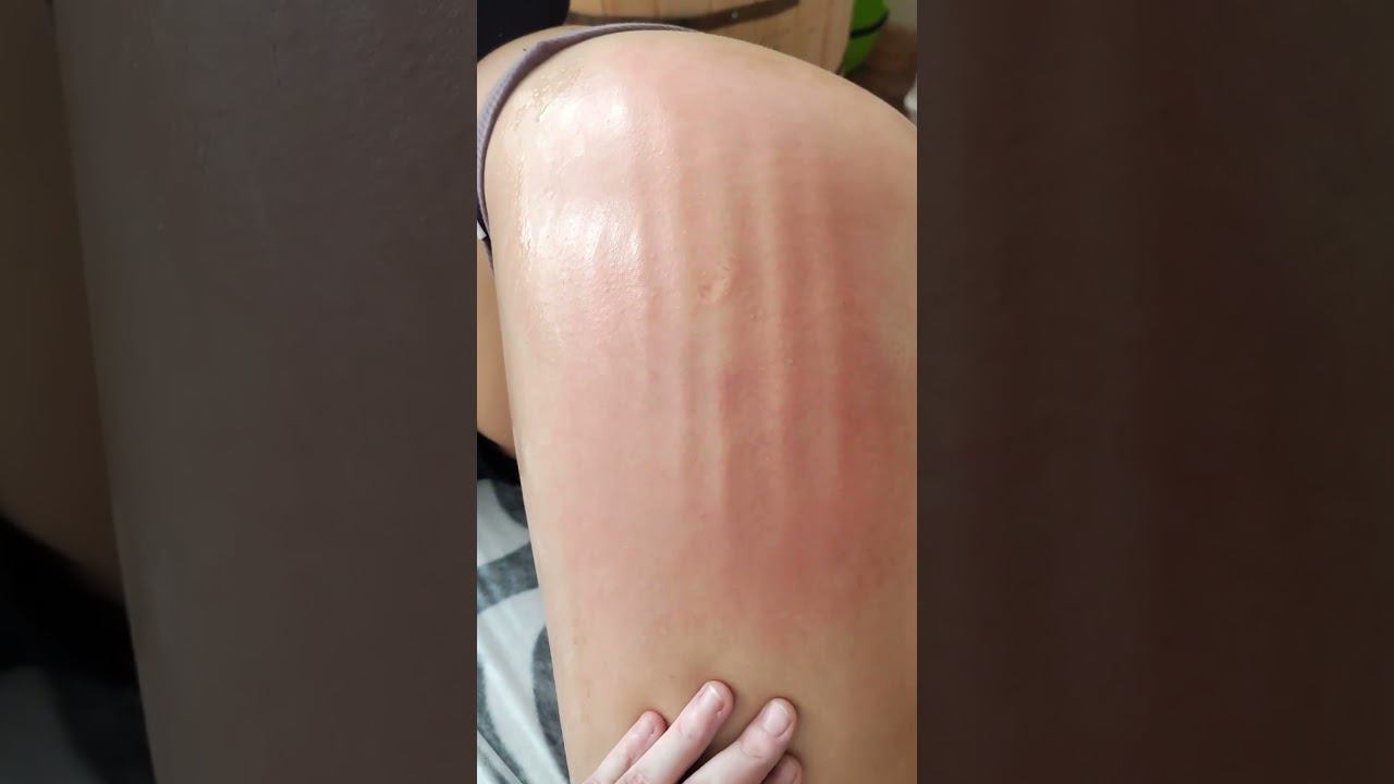 Ручная липопластика #shortvideo #massage #массаж #music #tiktok #youtubeshorts #shorts #liposuction