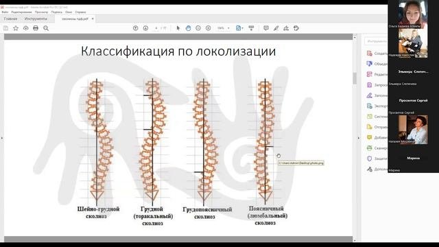 С-образный сколиоз. Закрытый вебинар по ошибкам при лечении сколиозов.
