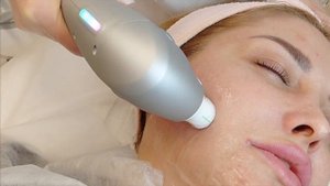 Ультраформер - убираем подбородок, подтяжка нижней трети лица