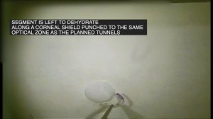 Asymmetric Femto-cut CAIRS by Dr. Shady Awwad using the Ziemer LDV Z8