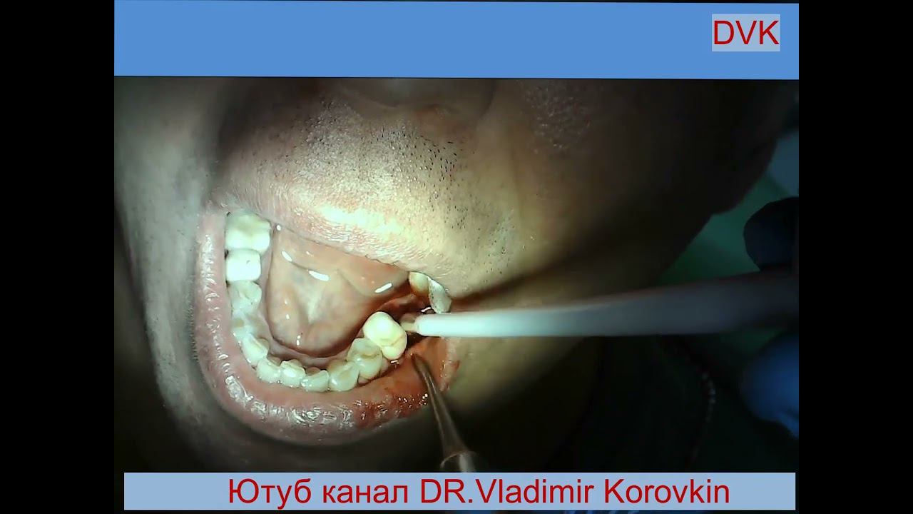 Jak przebiega proces ekstrakcji zęba.Rzeczywista sytuacja kliniczna zniszczenia zęba 36.