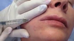 Меди-Лайт: Коррекция опущенных уголков рта филлером