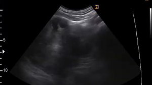 Кисты матки, миома с деструкцией? (9-2-17)