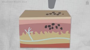 КАК УДАЛЯЮТСЯ ТАТУИРОВКИ. ПОДРОБНО И УВЛЕКАТЕЛЬНО.