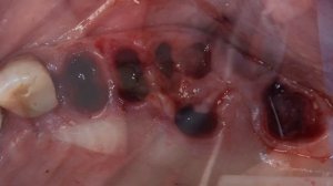 Immediate placement & sinus lift JD Icon plus. Dr.Bechara