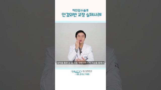 #하안검수술부작용 #하안검수술안검외반 #안검외반교정 смотреть онлайн