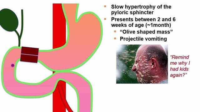 USMLE RX - 4.Желудочно-кишечный тракт - 2.Эмбриология - 1.Гипертрофический стеноз привратника