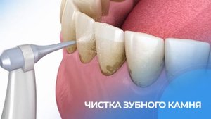 Потеря зубов НЕИЗБЕЖНА! Что делать при опущении десны?