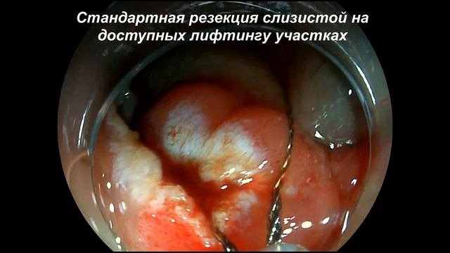 FTRD-система при полнослойной резекции слизистой
