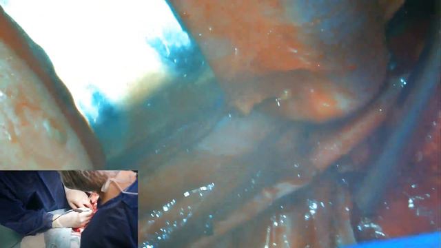 Ларингэктомия