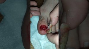 Удаление ногтя после травмы