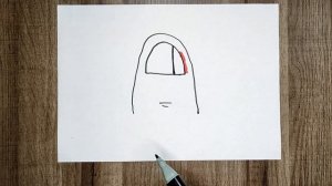 Ногти. Как лечить вросший ноготь. Коррекция вросшего ногтя.