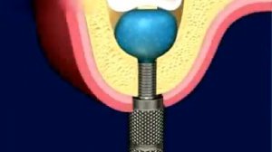 Синус лифтинг с поднятием пазухи