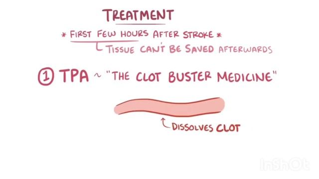Інсульт смотреть онлайн