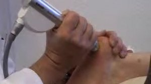 Лечение "Пяточной Шпоры" методом ударно волновой терапии