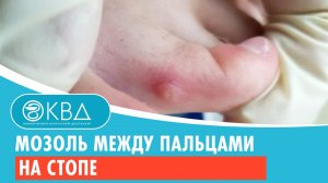 ? Мозоль между пальцами на стопе. Клинический случай №169