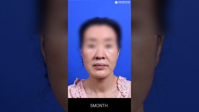 세월의 흔적을 되돌리는 안면목거상✨ 흘러내린 얼굴처짐 개선하기❤ смотреть онлайн