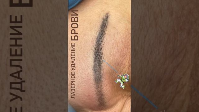 Лазерное удаление бровей
