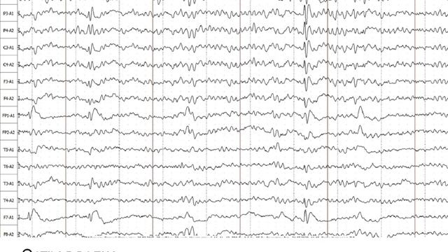 Признаки пароксизмальной активности на ЭЭГ смотреть онлайн