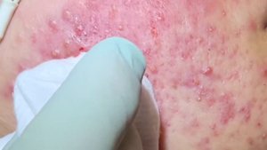 So much pop! Acne extractions on severe inflammatory acne. Multiple blackheads and whiteheads.
