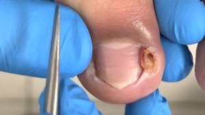 Perfectly trim paronychia and painlessly pull out ingrown nails【Xue Yidao Pedicure】