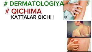 QICHIMA KASALLIGI SABABI , KLINIKASI , TOSHMA QANDAY VA DAVOLASH #dermatology #khan #retseptlar