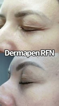 ДО-ПОСЛЕ Dermapen RFN игольчатый RF