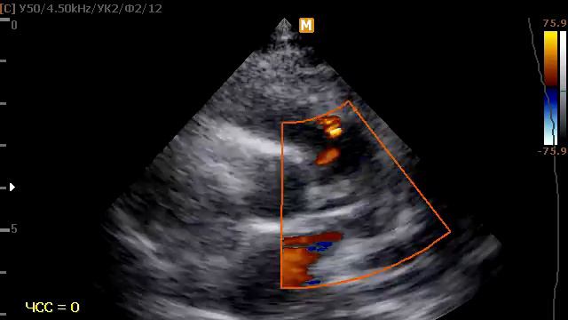 Коронарно-легочная фистула смотреть онлайн