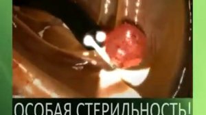 Колоноскопия