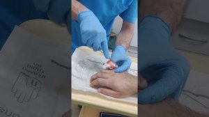 извлечение спиц из кисти после перелома костей кисти
