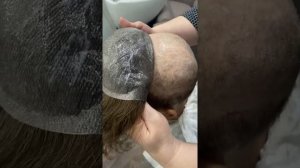 Установка системы волос интеграции при рубцовой алопеции
