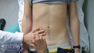 Симптом Раздольского при перитоните