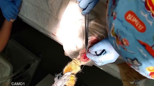 Внеочаговая фиксация перелома. смотреть онлайн