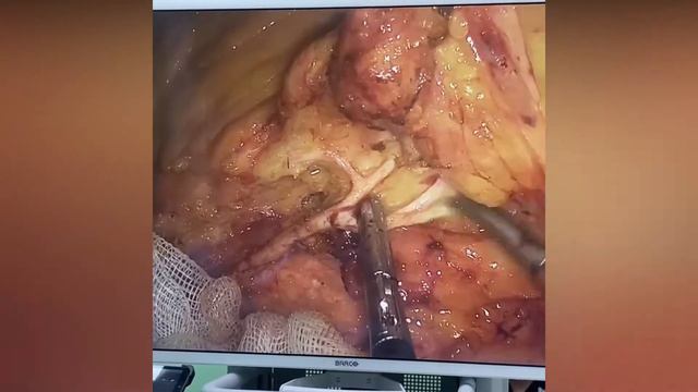 «Можно ли избежать гемиколэктомии»? смотреть онлайн