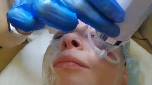 Микроигольчатый RF-лифтинг — это современная аппаратная процедура смотреть онлайн