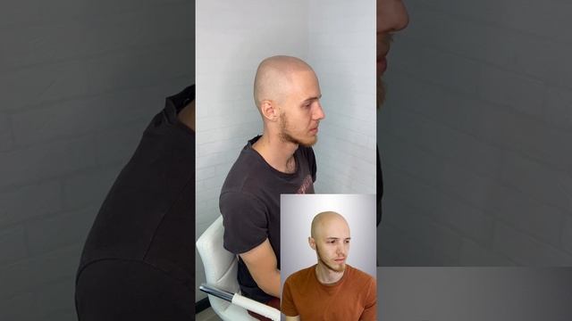 Лысина осталась в прошлом #трихопигментация #scalpmicropigmentation #татуволос #shorts