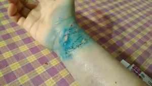 Укус тигрового питона