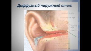 Отит ныряльщика