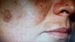 Отбелить лицо! Перекись водорода от пигментации!