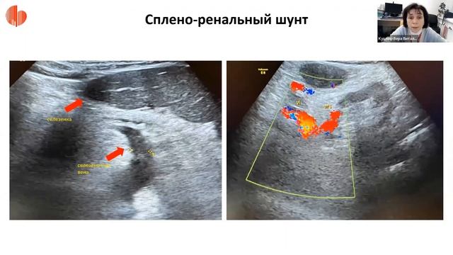 Клиническая роль оценки печёночного кровотока при ЛАГ, ассоциированной с портальной гипертензией смотреть онлайн