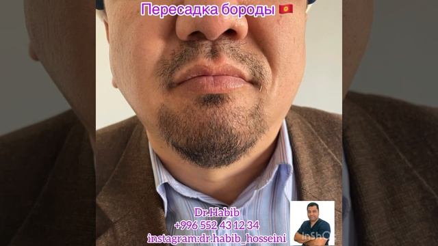 Пересадка бороды